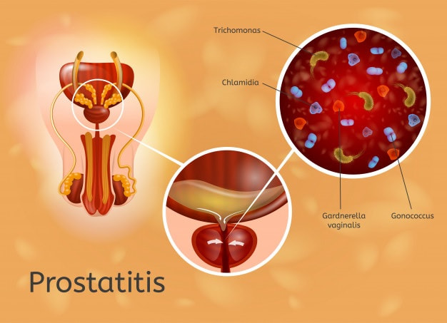 prostatitis vector medical chart with reproductive by Primalis Việt Nam on 500px.com