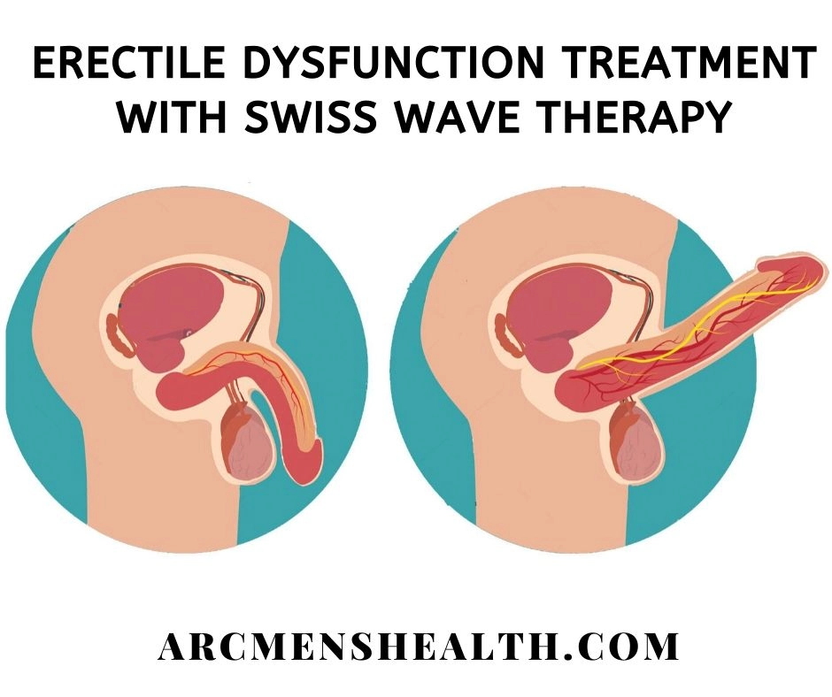Impact on the Quality of Erections after Acoustic Therapy Treatment