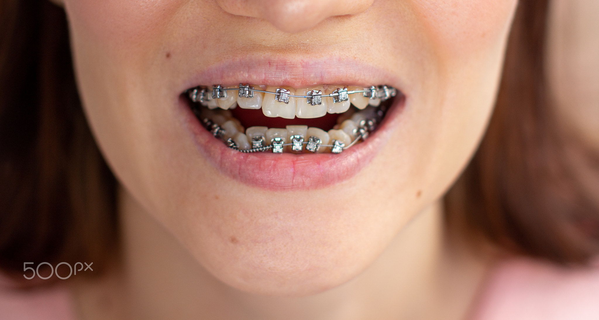 brasket system in smiling mouth, macro photo teeth, close-up lips