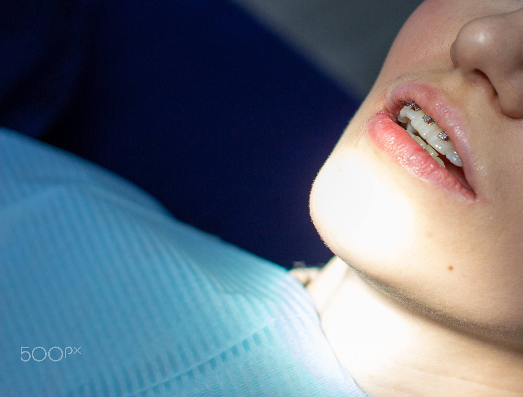 A woman at a dentist's appointment to replace arches with braces.