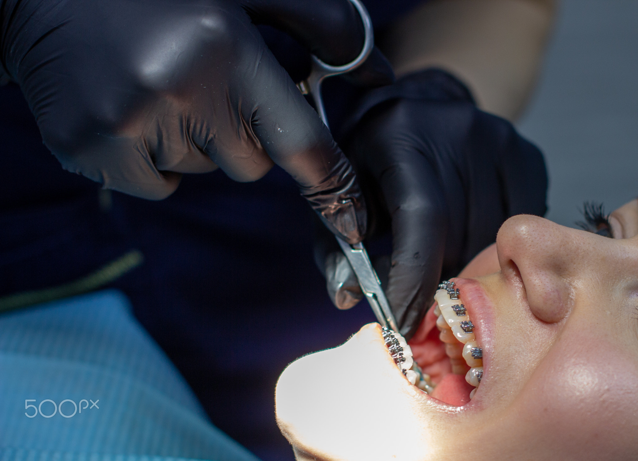 A woman at a dentist's appointment to replace arches with braces.