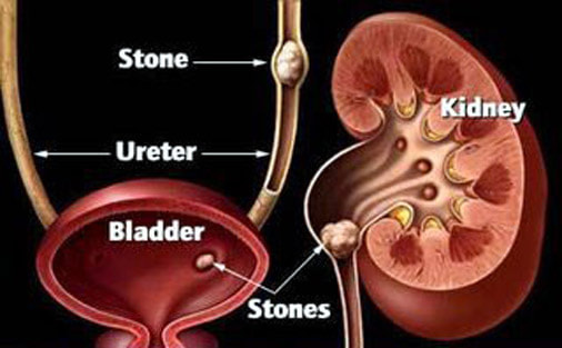 Urinary Stone Treatment in Pune-Kidney Stone Treatment in Pune