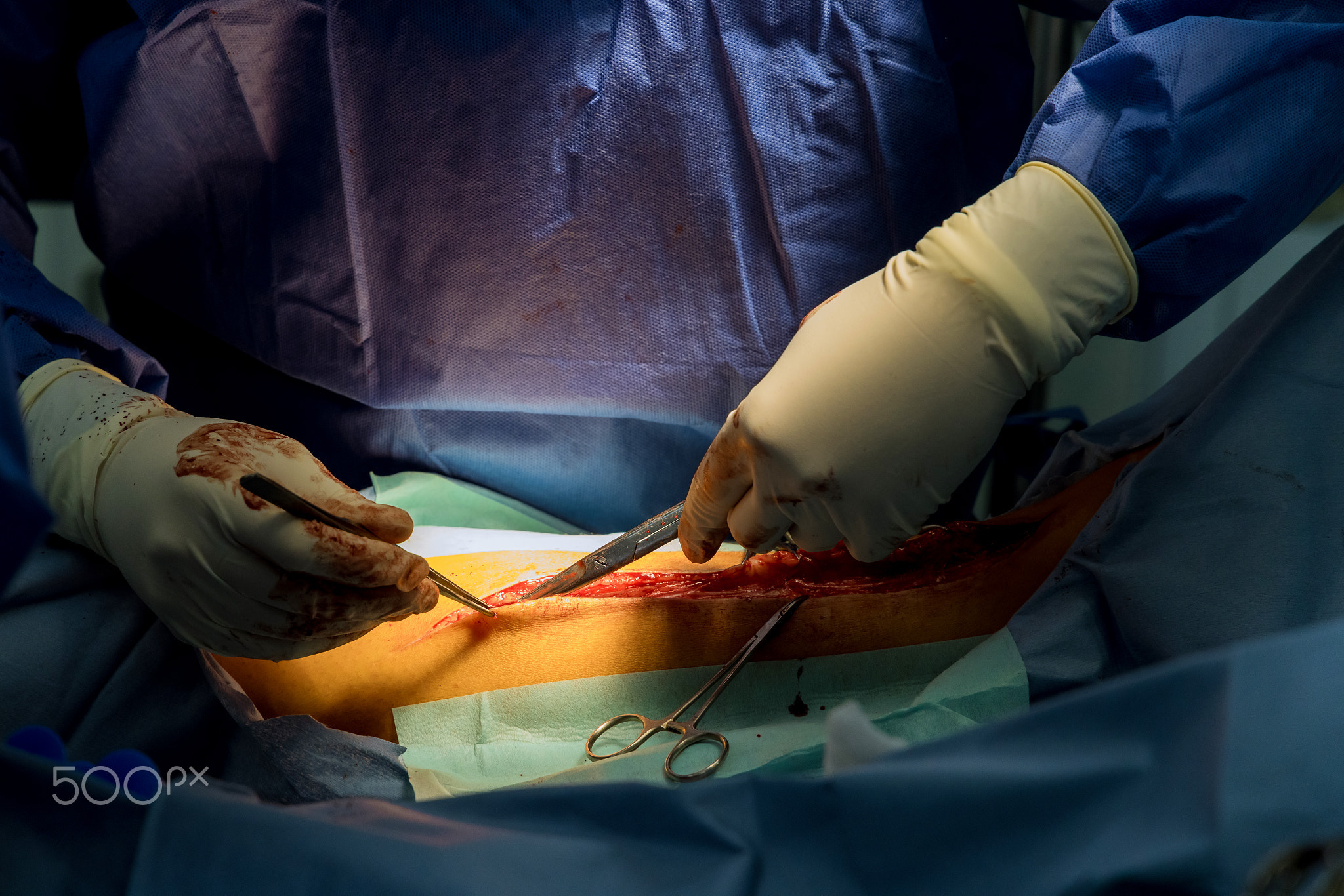 Operating during surgery with cutting legs for internal intervention
