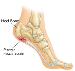 Sports & Spine Rehabilitation Center: Plantar Fasciitis