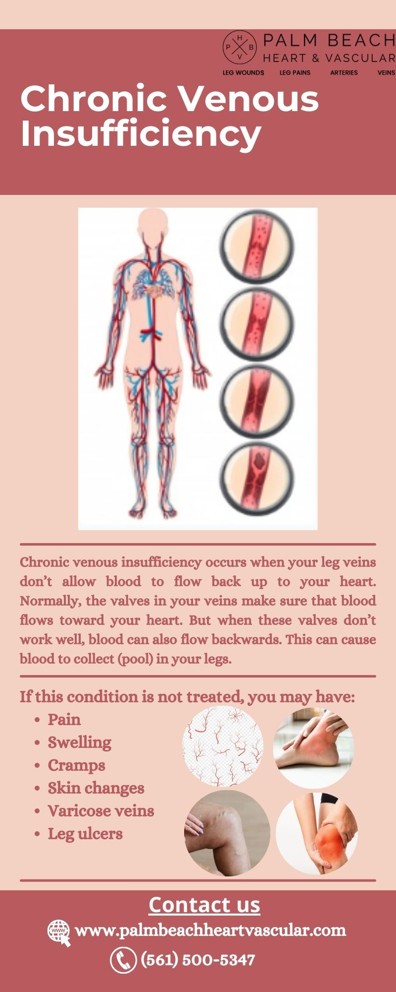 Chronic Venous Disease