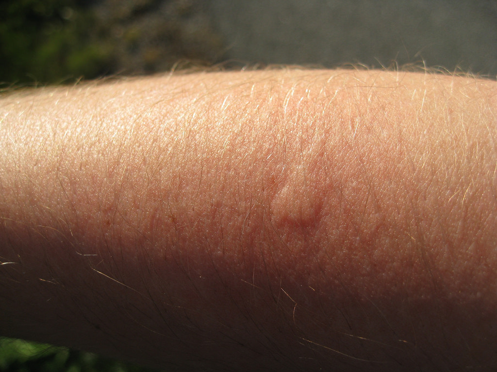 First Aid for Mosquito Stings
