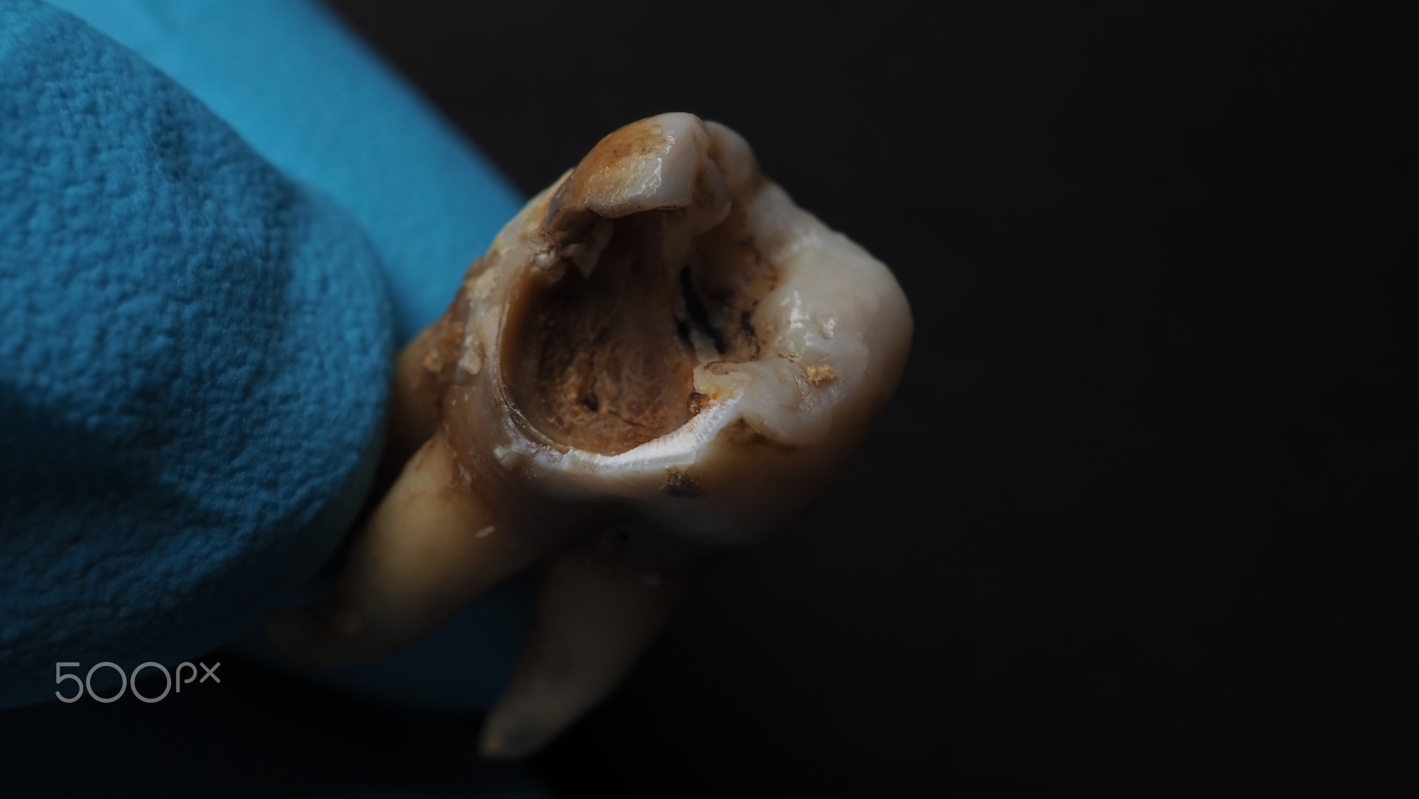 Tooth decay and dentist hand with glove and black background. 