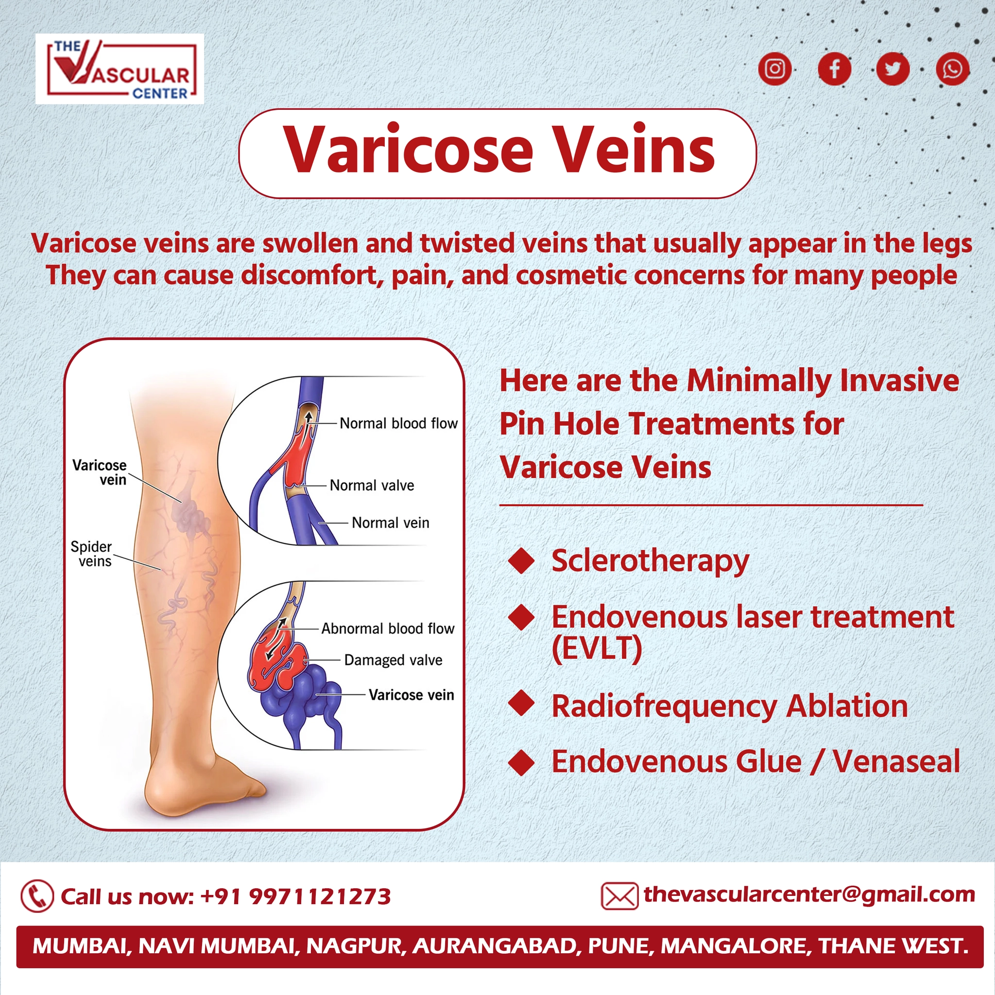 Varicose Veins- The Vascular Center