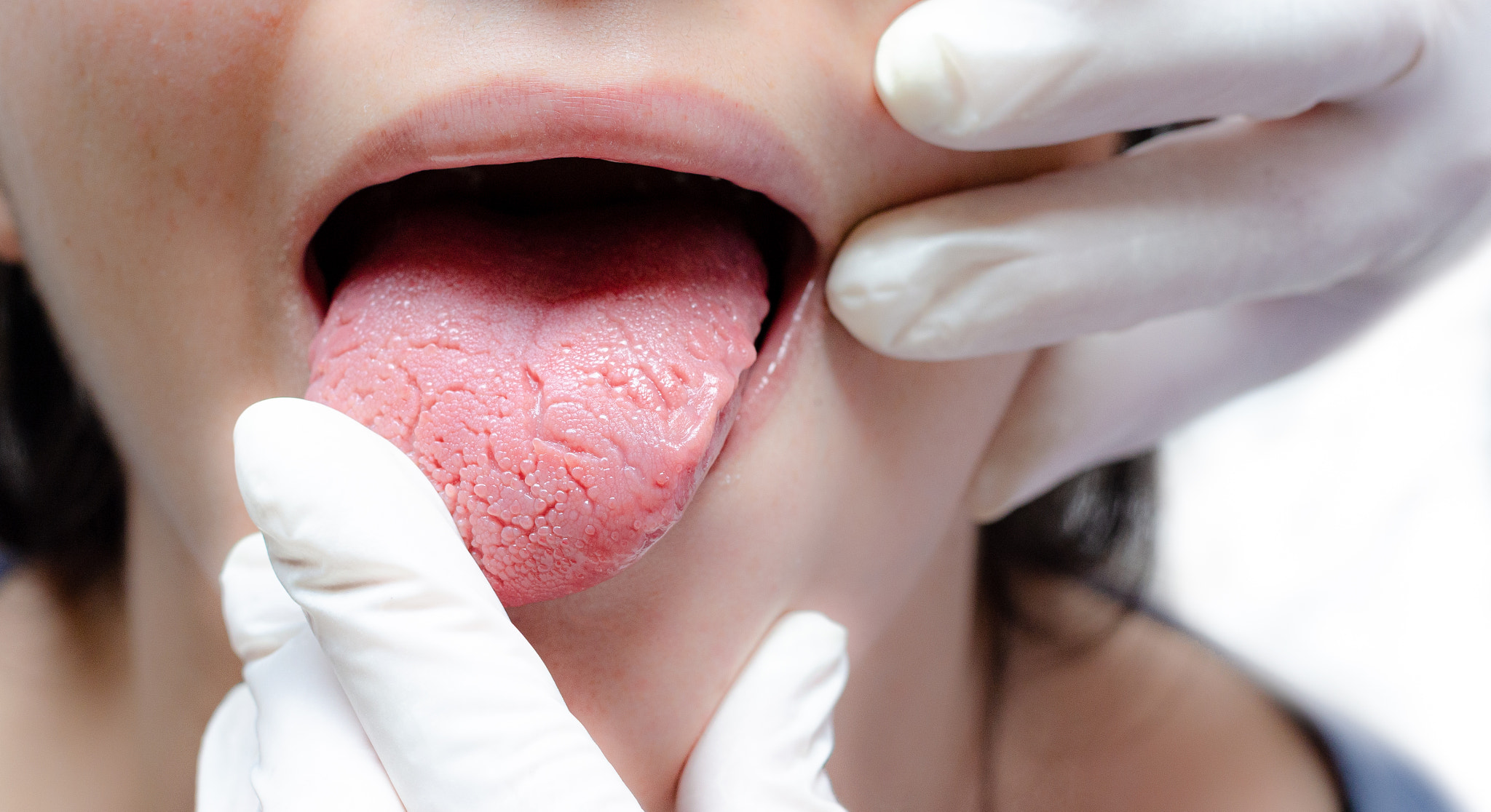 Tongue beningn migratory glossitis, candidiasis tongue, woman, doctor gloves.