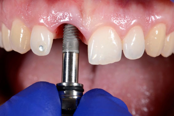 Best Dental Implant Treatment in Juhu, Mumbai