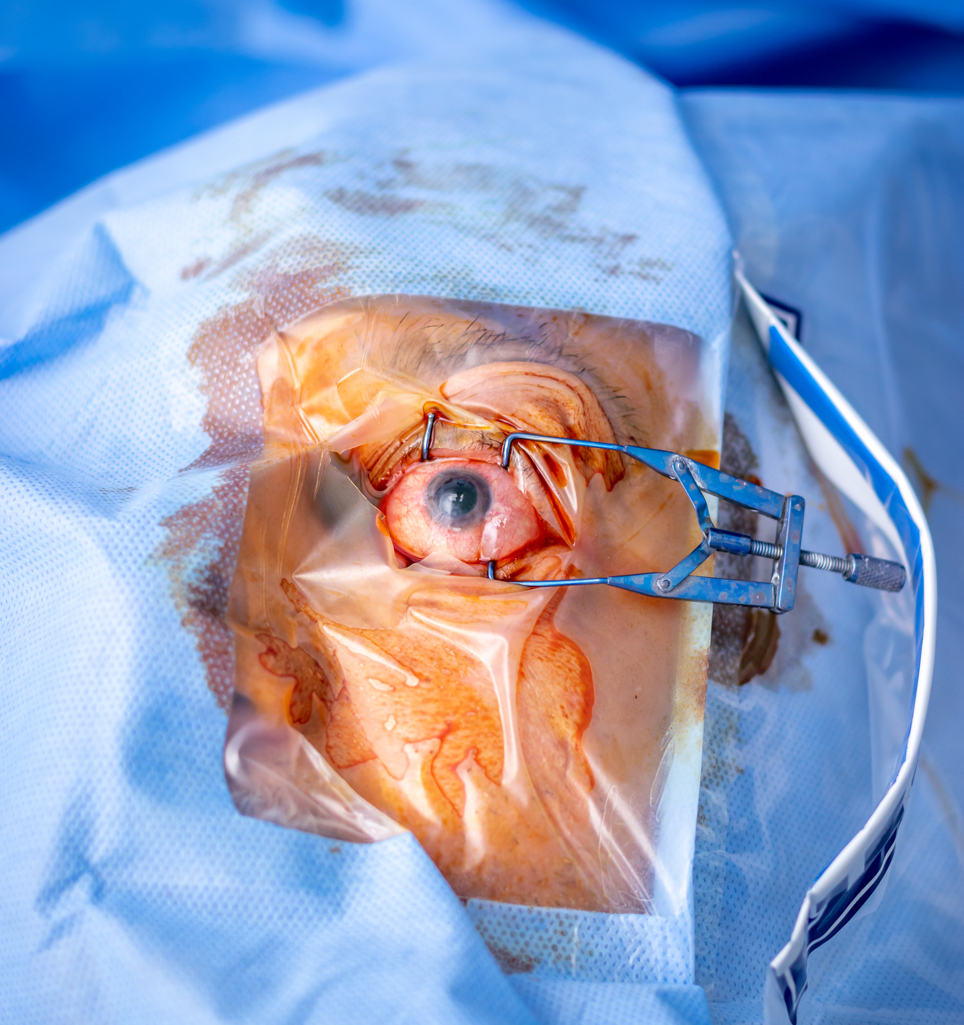 Phacoemulsification, destruction of the opaque lens by ultrasound