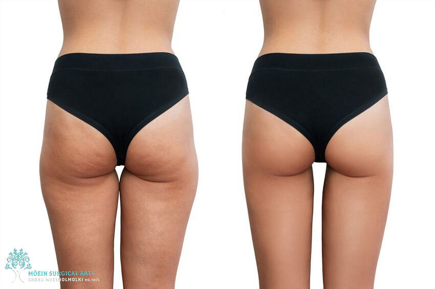 Cellulite Treatments Los Angeles | Moein Surgical Arts