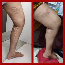 How Much Does Varicose Vein Treatment Cost?