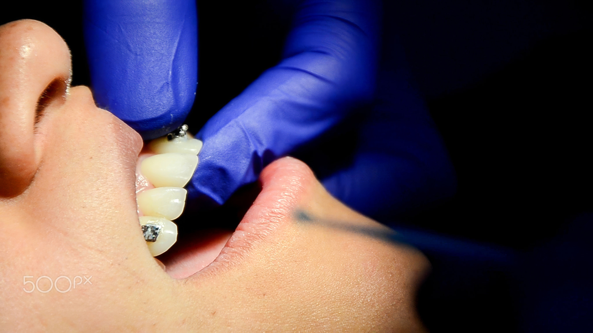 Dental shade matching procedure close-up