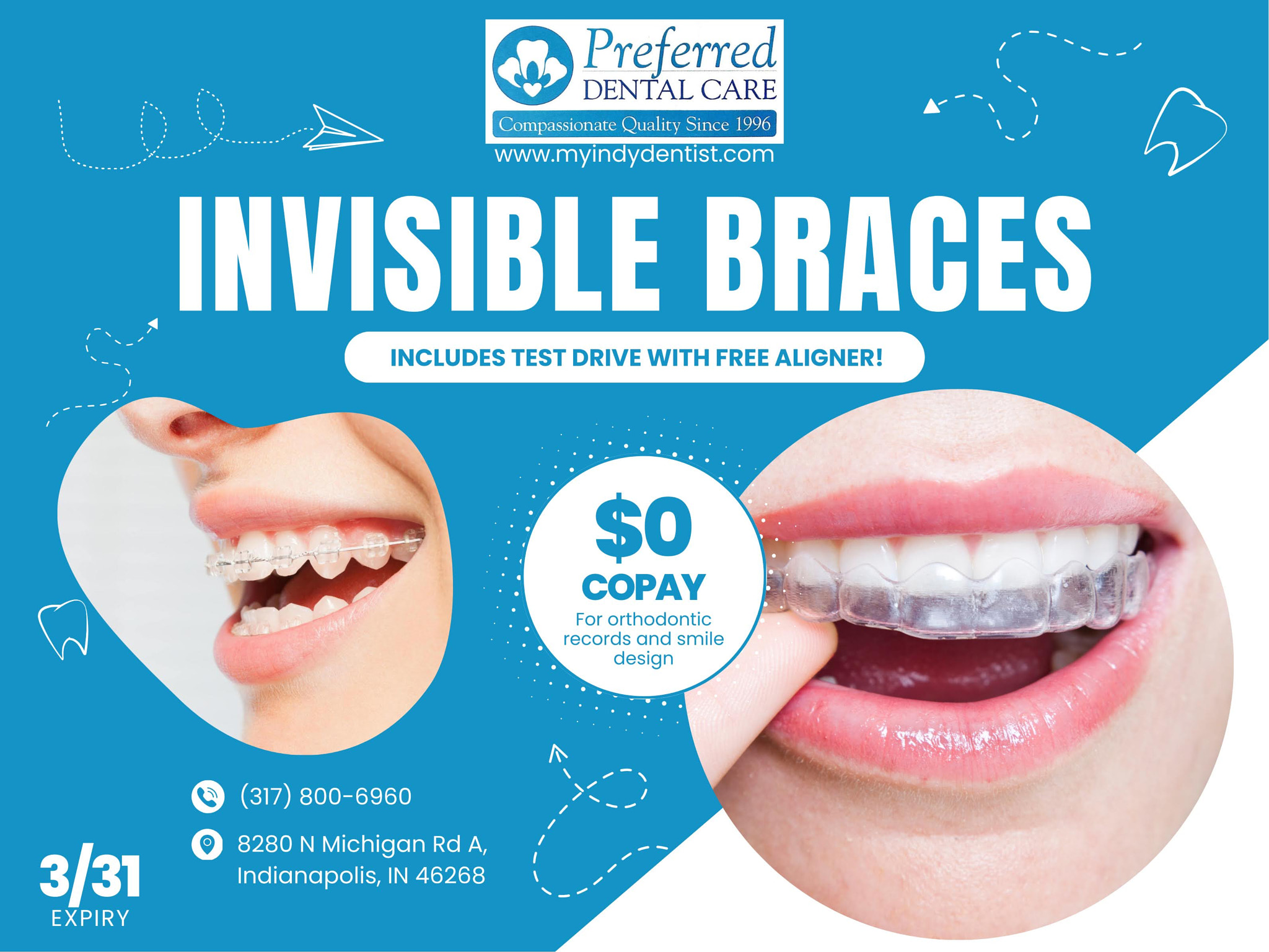 Invisible Braces Indianapolis IN