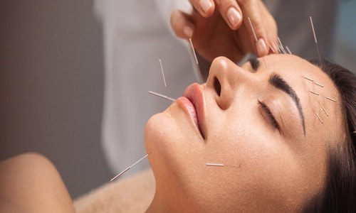 Acupuncture for Anxiety: Does it Work? | Fluent Health