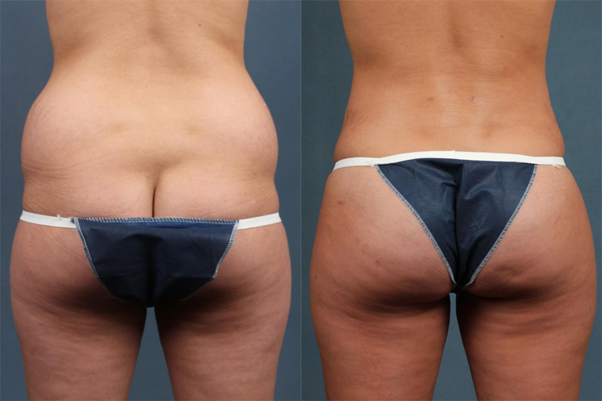 Tummy Tuck Newport Beach CA