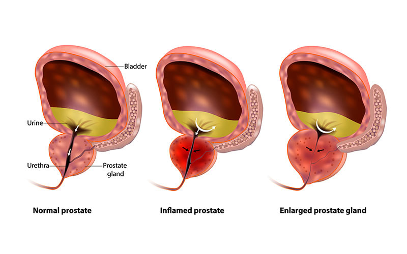 enlarged-prostate-treatment-SCIHospital