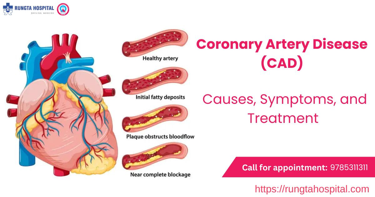 Coronary Artery Disease (CAD): Causes, Symptoms, and Treatment