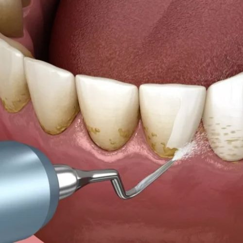 Your Guide to Affordable Cosmetic Veneers in NYC: Smile Confidently