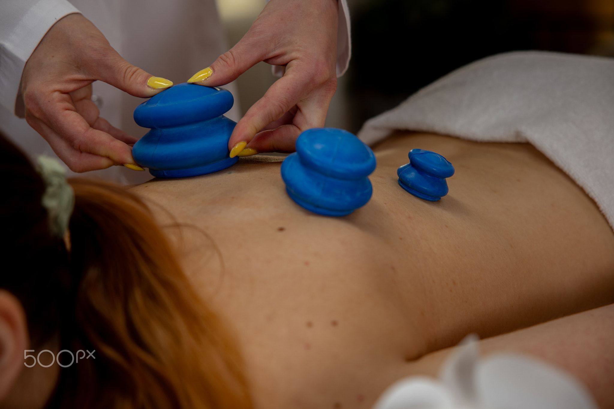 Therapeutic Cupping Therapy Utilizing Unique Blue Cups for Enhanced Healing and Balance