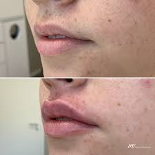 Lippenfüller in Wien - Vienna Aesthetic Center