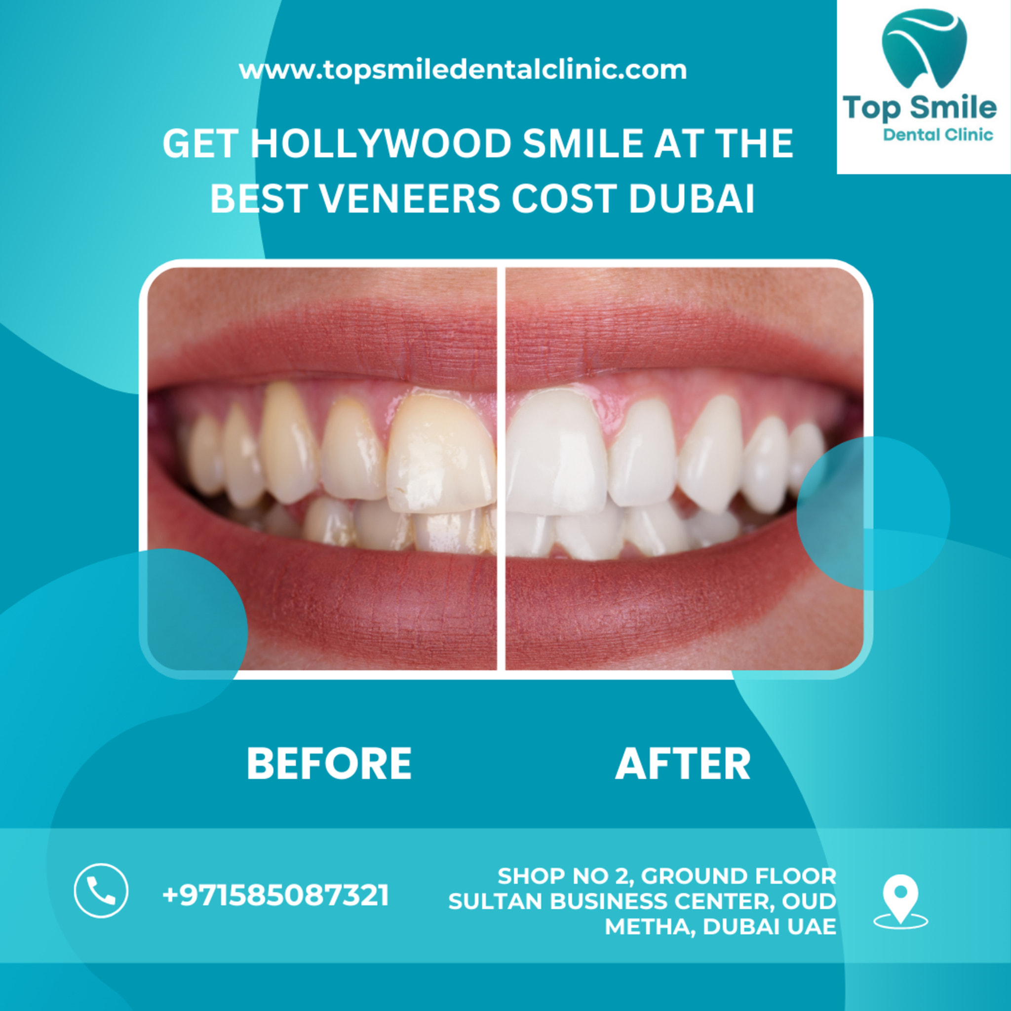 Dubai Veneers Cost: Get a Hollywood Smile! | Best Veneers in Dubai at Affordable Prices