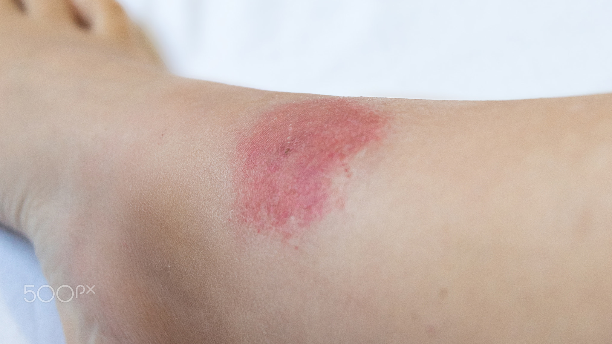 allergic reaction to an insect bite. Allergy to wasp and mosquito bites