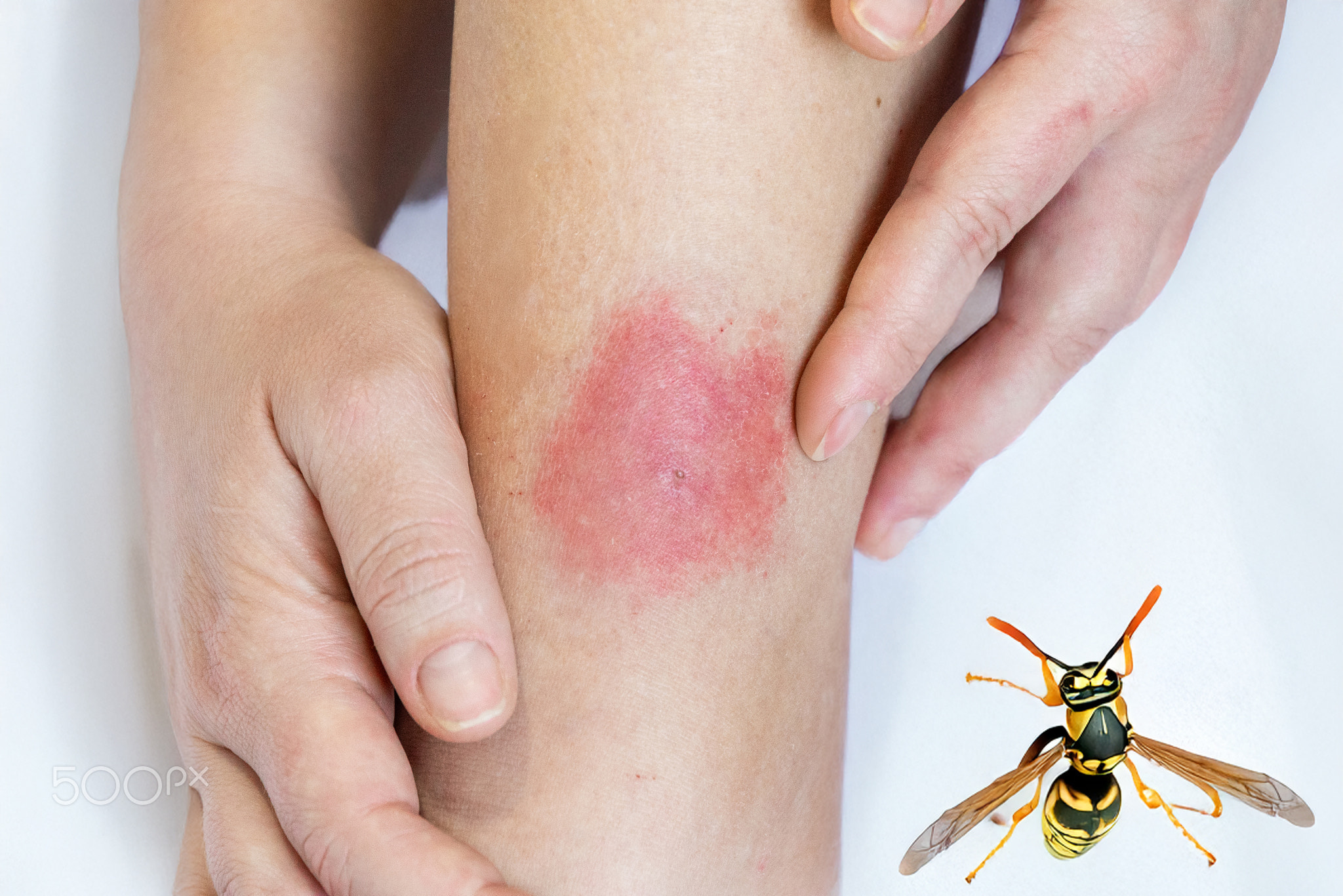 allergic reaction to an insect bite. Allergy to wasp and mosquito bites
