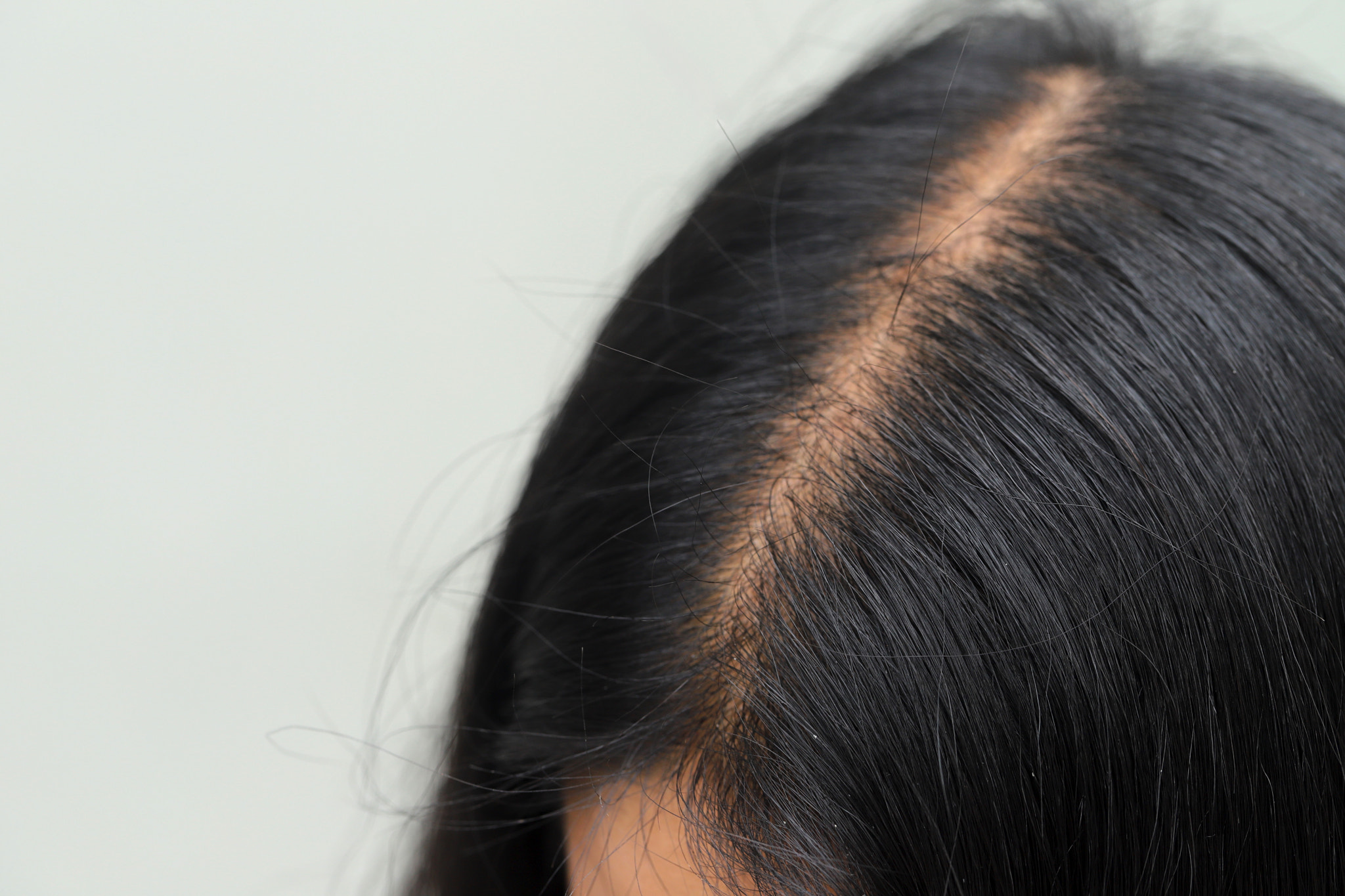 Women with hair loss dryness and frizziness\t