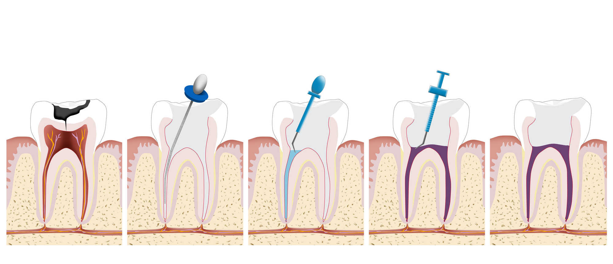 Schmerzfreie Wurzelkanalbehandlung bei Zahnärzte Zürich Gartenstrasse