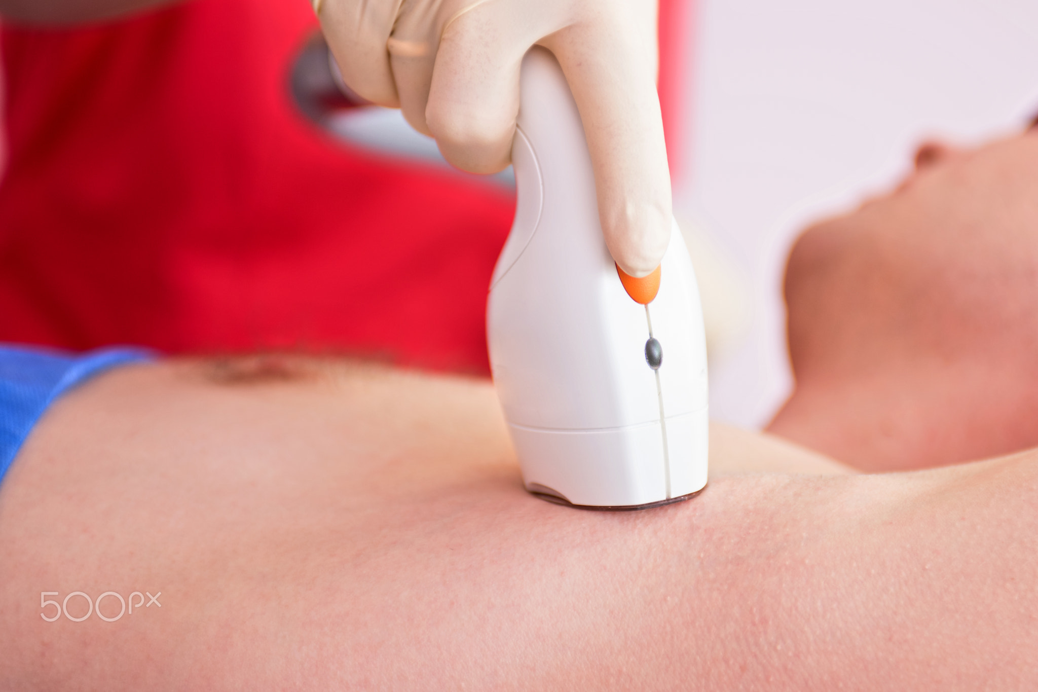 male laser epilation