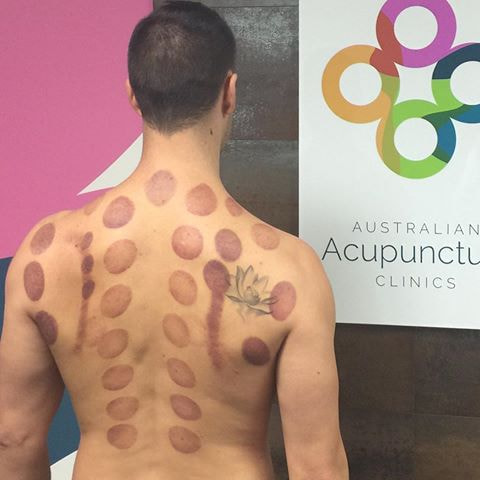 Get Acupuncture for Anxiety Free Life