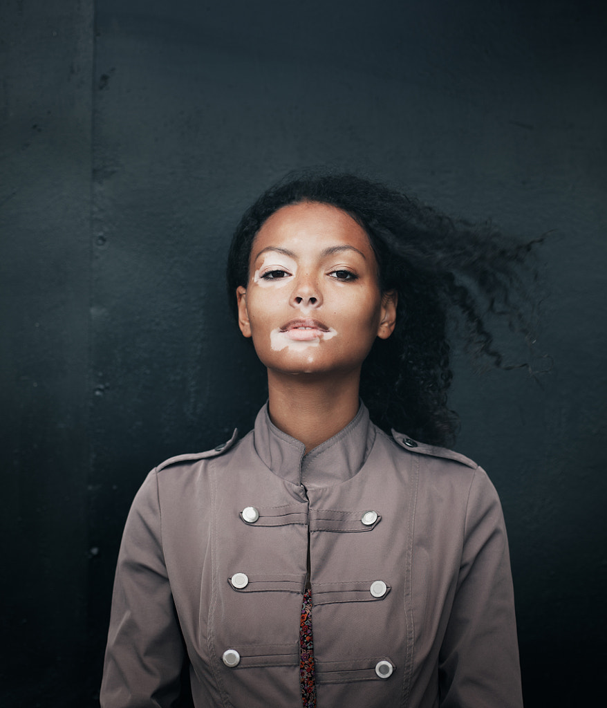 beautiful young brunette woman with vitiligo disease by Andrii Afanasiev on 500px.com