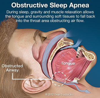 Snoring And Sleep Apnea Easton