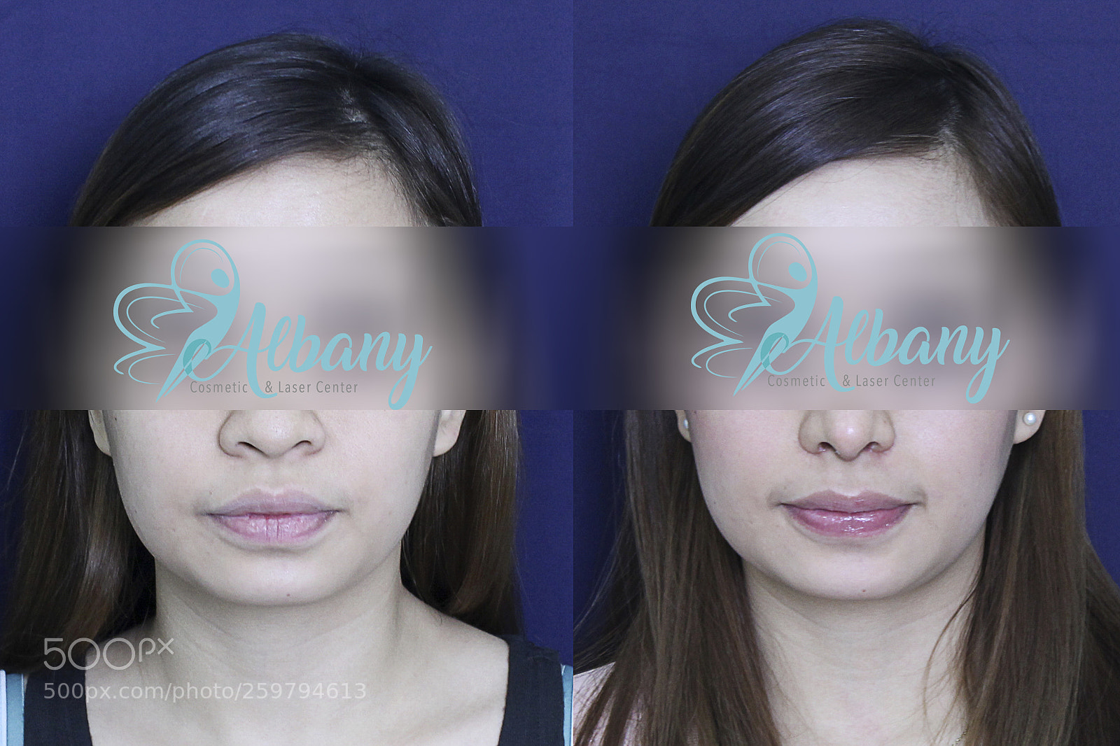 Canon EOS 1100D (EOS Rebel T3 / EOS Kiss X50) sample photo. Face slimming botox may photography