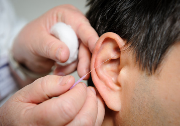 Acupuncture. Needles being inserted into a patient's skin