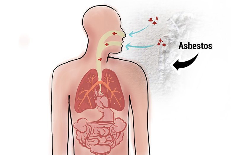 Cause of peritoneal mesothelioma is exposure to asbestos